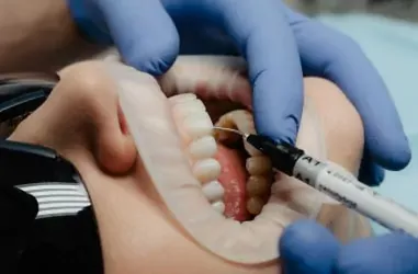 Вініри: види, ціни, особливості встановлення | DENTART Вініри: види, ціни, особливості встановлення