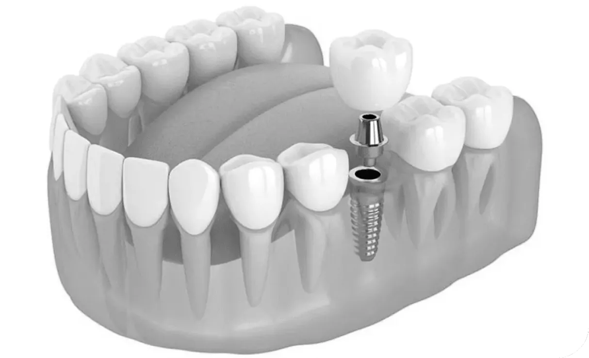 Implant-supported prosthetics