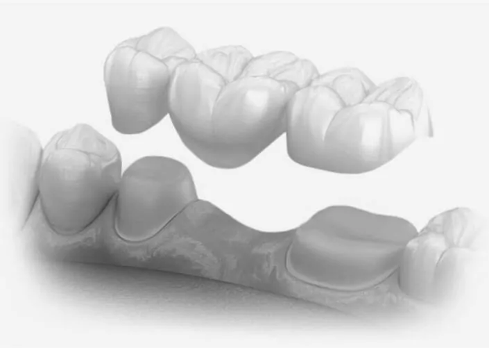 Dental Bridges