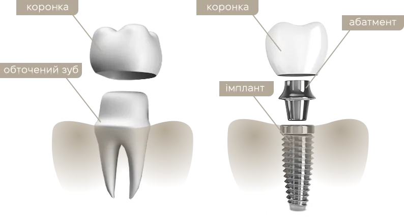 What is a dental crown? | DENTART What is a dental crown?