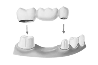 Stages of Dental Prosthetics Fitting and installation of the prosthetic structure