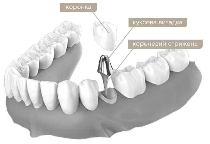 Что такое культевая вкладка и для чего она нужна? | DENTART Что такое культевая вкладка и для чего она нужна?