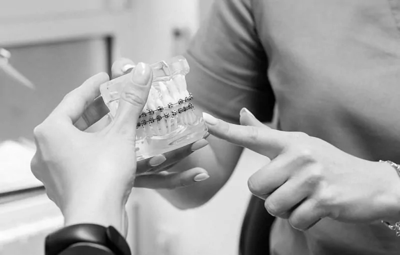 Самолігуючі брекети: головні особливості | DENTART Самолігуючі брекети: головні особливості