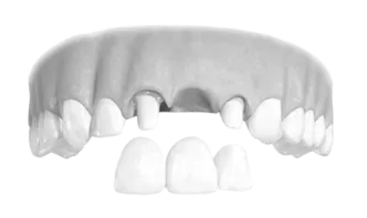 Stages of Dental Prosthetics Preparation