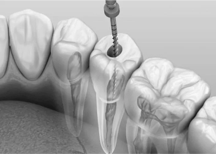 Ендодонтичне лікування каналів зуба | DENTART Ендодонтичне лікування каналів зуба