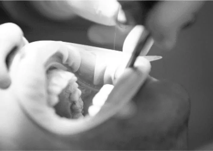 Лікування ускладнень карієсу | DENTART Лікування ускладнень карієсу