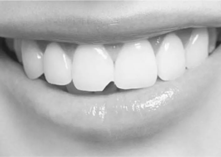 Реставрация зубов | DENTART Реставрация зубов
