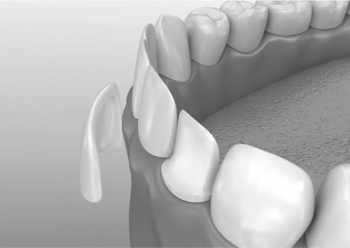 Tooth restoration with veneers