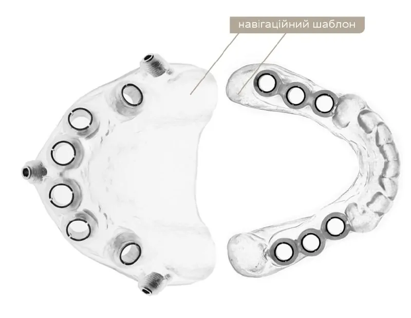 What is a surgical template? | DENTART What is a surgical template?