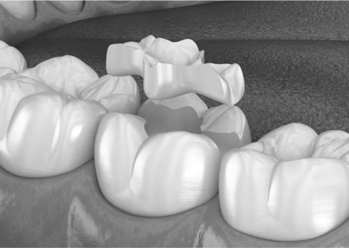 What are ceramic inlays? | DENTART What are ceramic inlays?