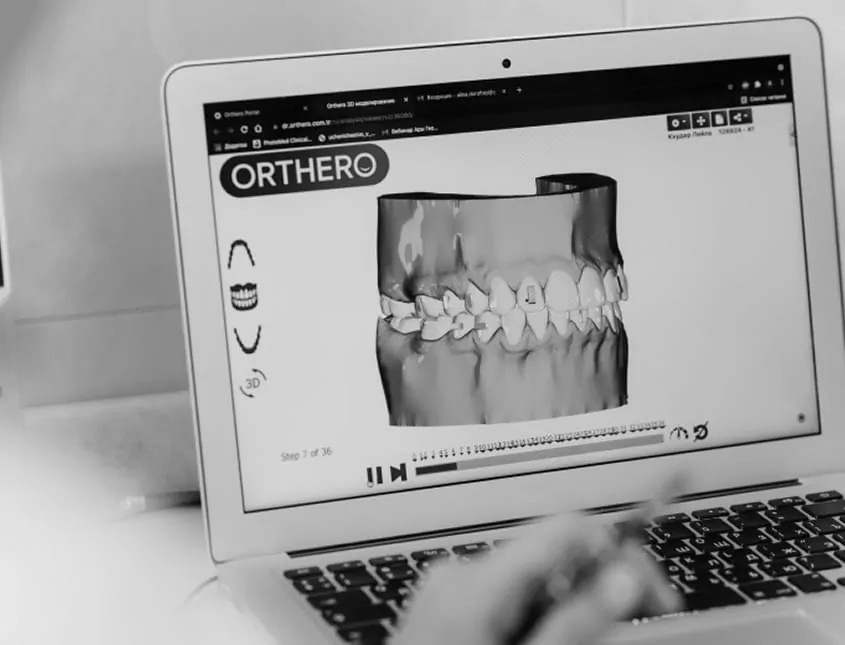 Stages of treatment with orthodontic aligners 
